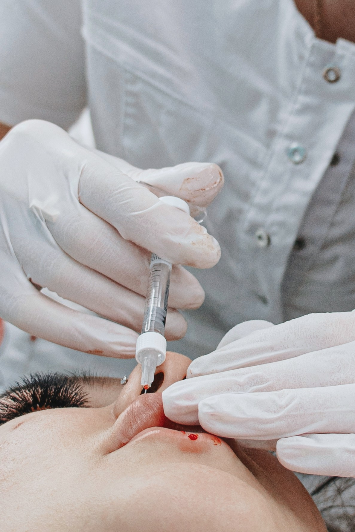 Косметолог проводит контурную пластику губ, игла вводит препарат в верхнюю губу