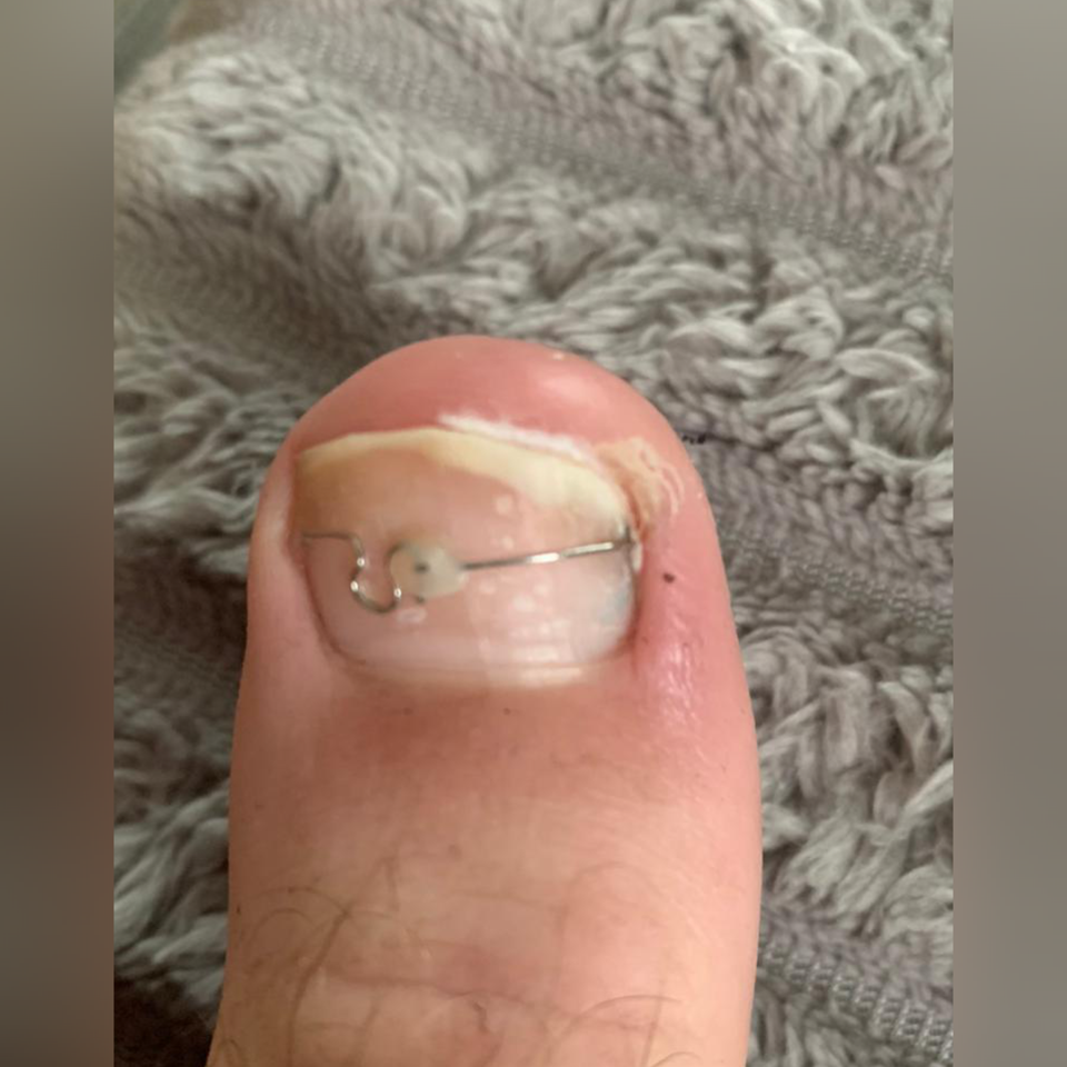 Решение проблемы вросшего ногтя. Подолог г. Хабаровск — центр здоровой стопы «FOOTTIME»