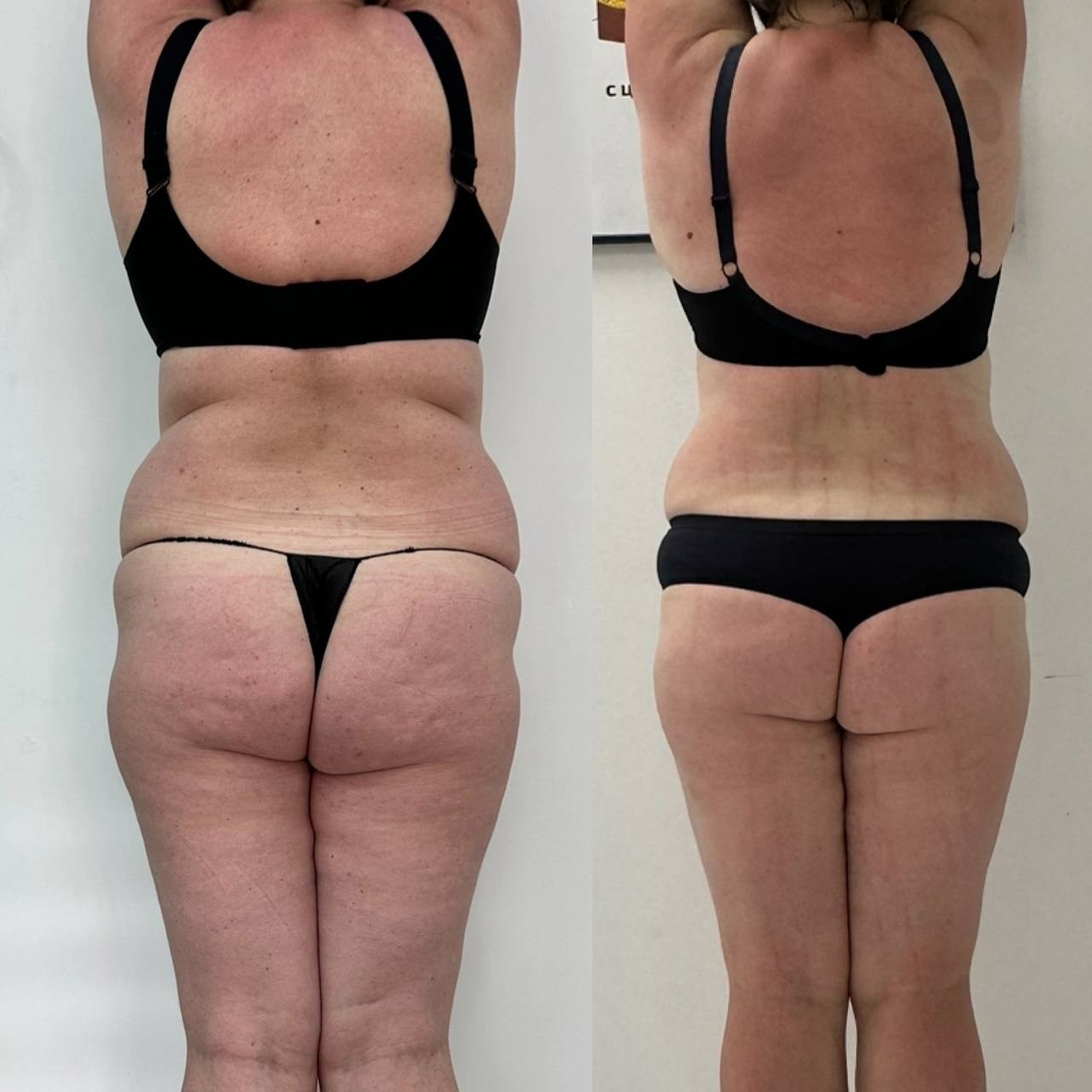 Результаты. Центр Коррекции Тела в городе Чехов