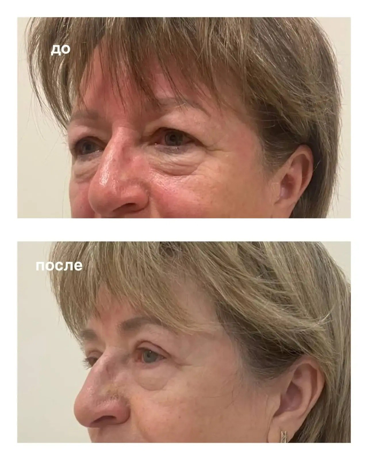 Результат круговой блефаропластики через месяц после операции 💥. Горбачевская Ксения Андреевна — пластический хирург