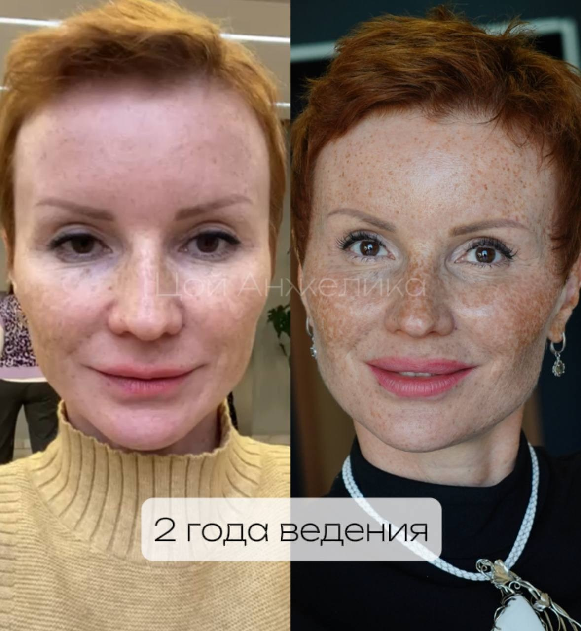 Естественное омоложение. Главная