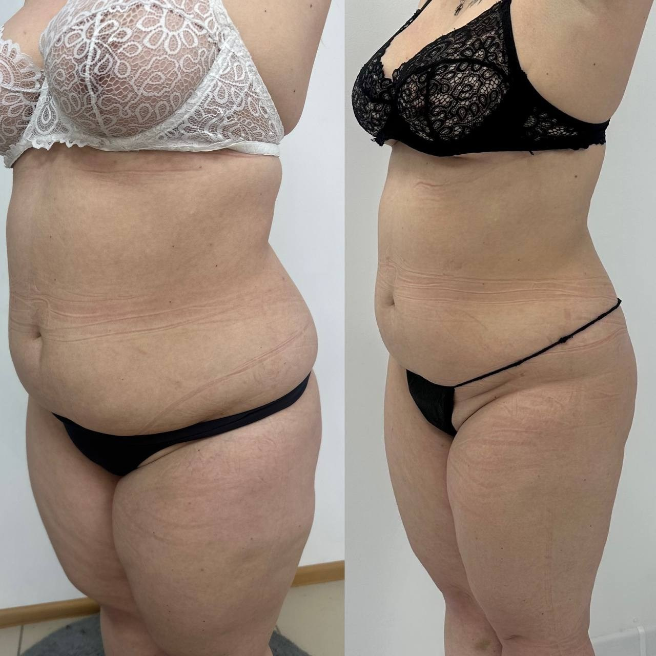 Результаты. Центр Коррекции Тела в городе Чехов