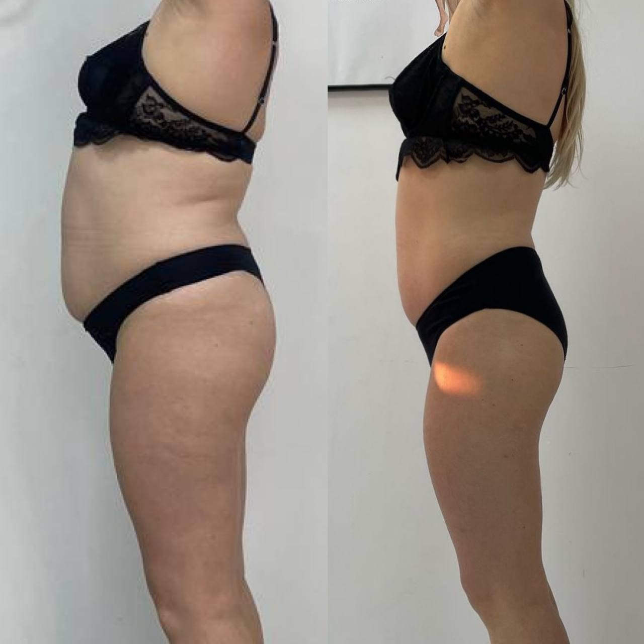 Результаты. Центр Коррекции Тела в городе Чехов