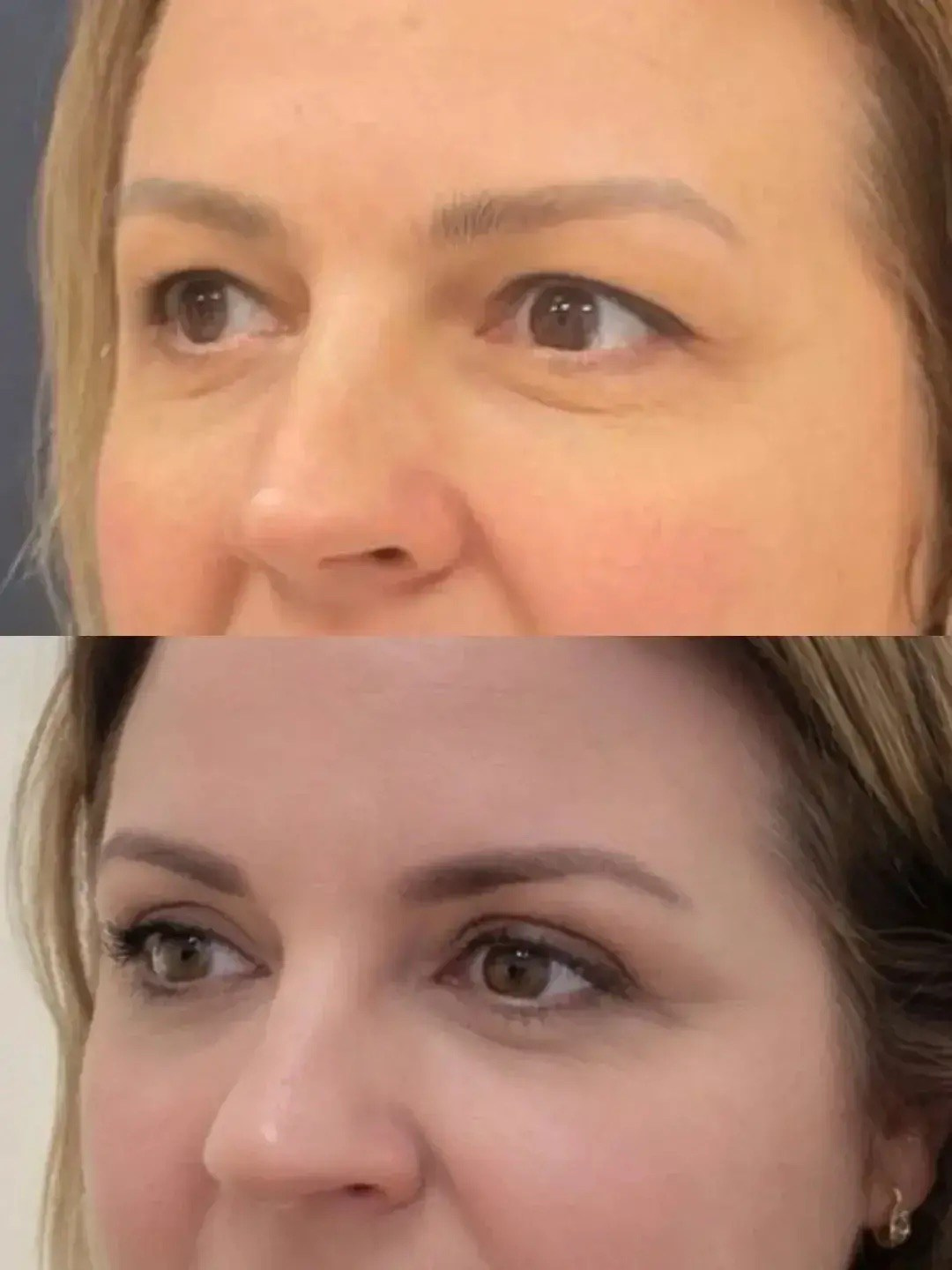 Результат круговой блефаропластике через месяц после операции. Горбачевская Ксения Андреевна — пластический хирург