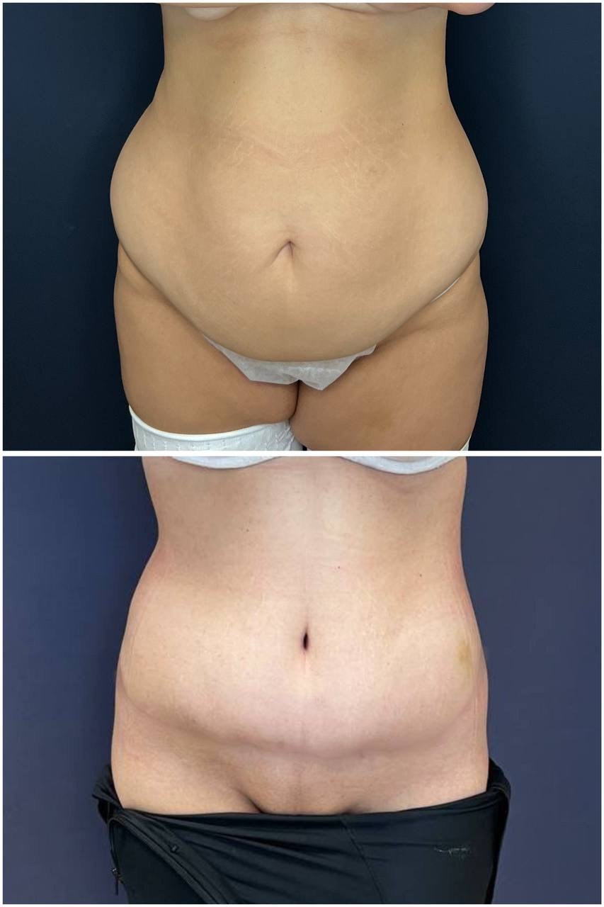 Всех приветствую! Результат нижнего бодилифтинга через 2 месяца после операции. Горбачевская Ксения Андреевна — пластический хирург