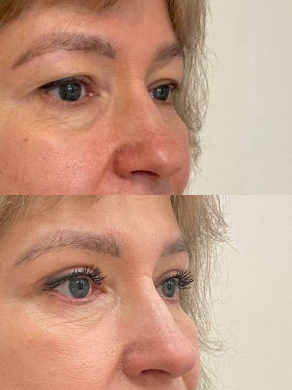 Блефаропластика и лифтинг верхних век. Горбачевская Ксения Андреевна — пластический хирург