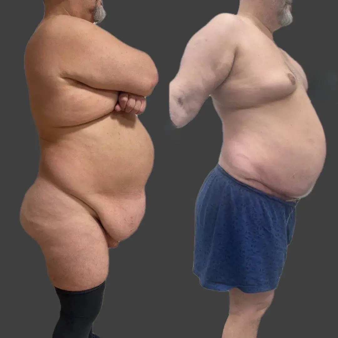 Выполнена абдоминопластика с переносом пупка, удален фартук в объеме 8 кг. Горбачевская Ксения Андреевна — пластический хирург