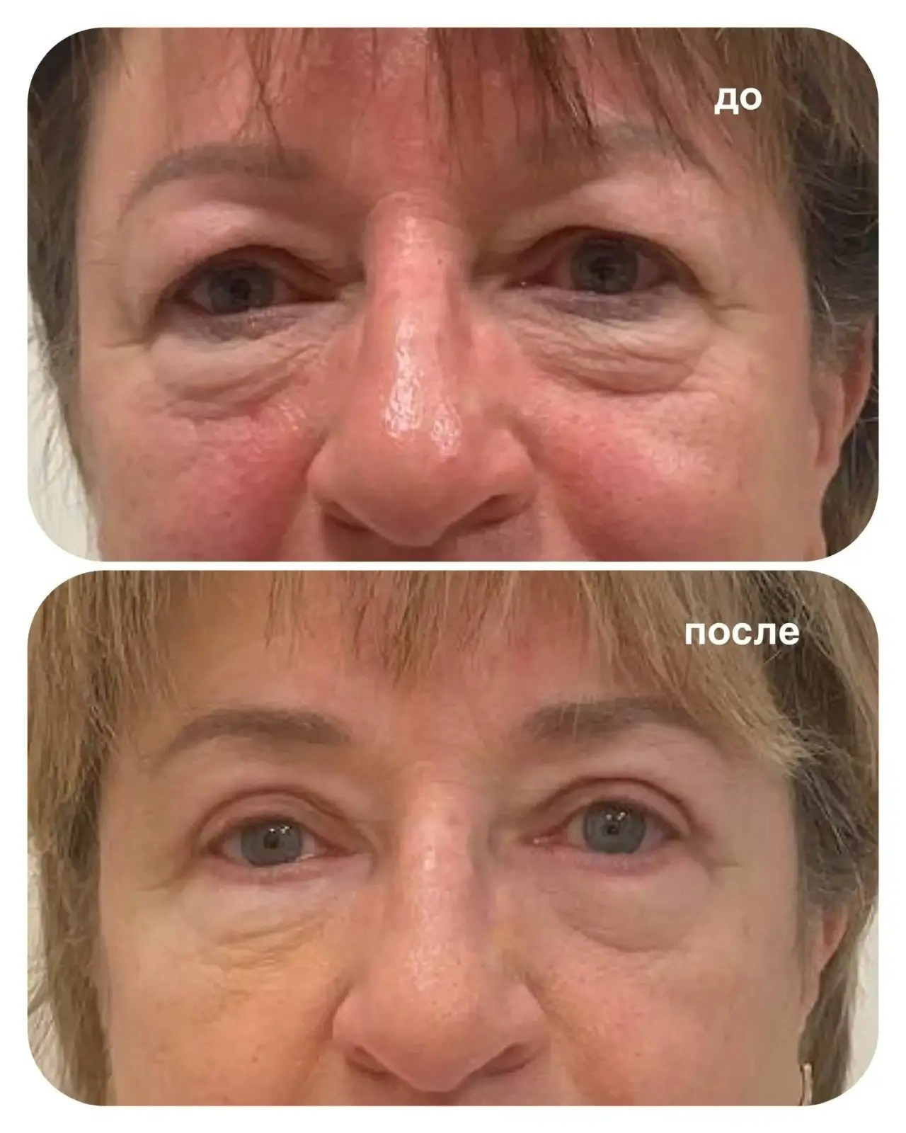 Результат круговой блефаропластики через месяц после операции 💥. Горбачевская Ксения Андреевна — пластический хирург