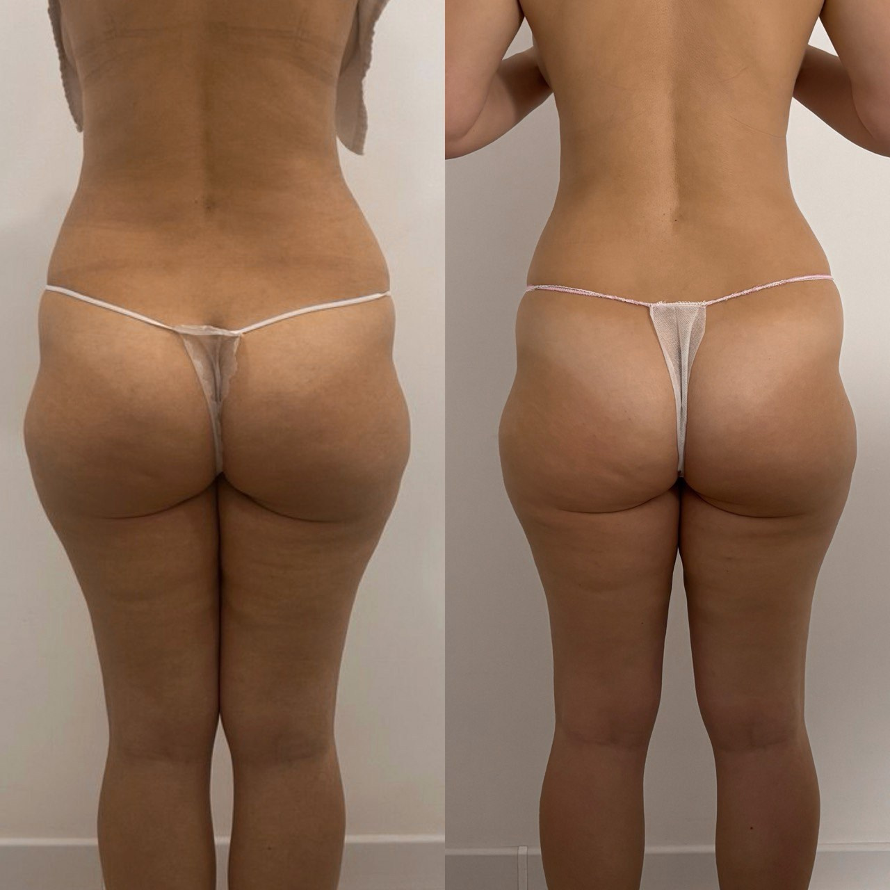 Аппаратный массаж BBEndospheres