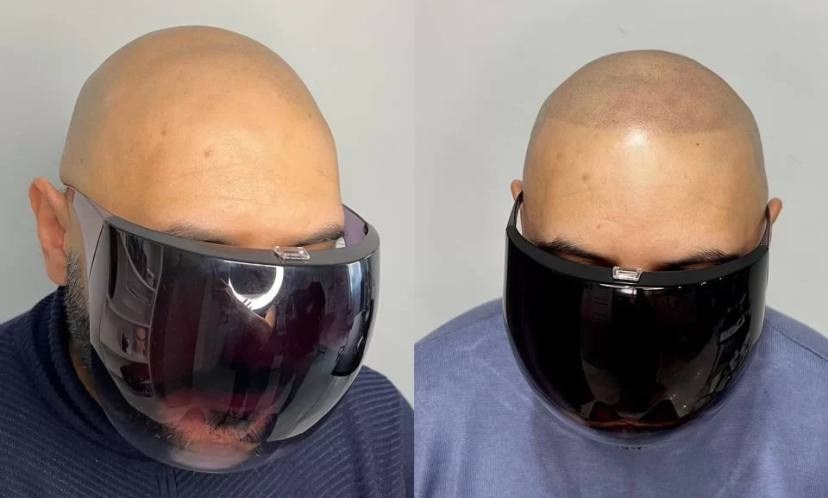 Нажмите на фото что бы открыть. SMP Трихопигментация Воронеж Волгоград Москва Казань Никита Нестеров