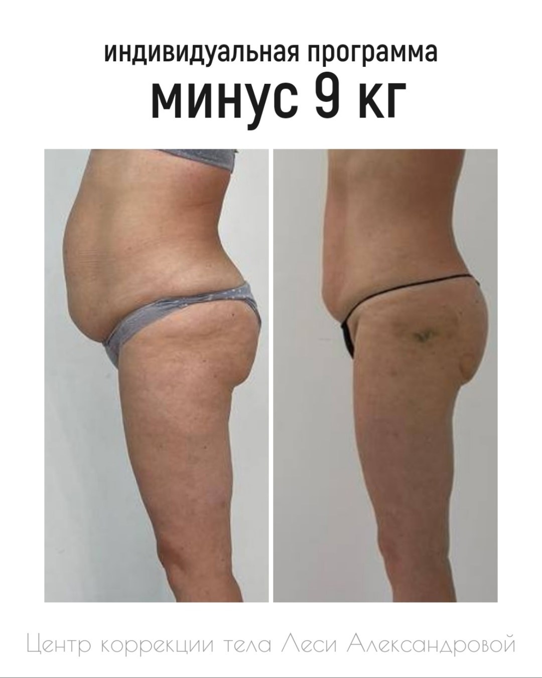 Результаты. Центр Коррекции Тела в городе Чехов