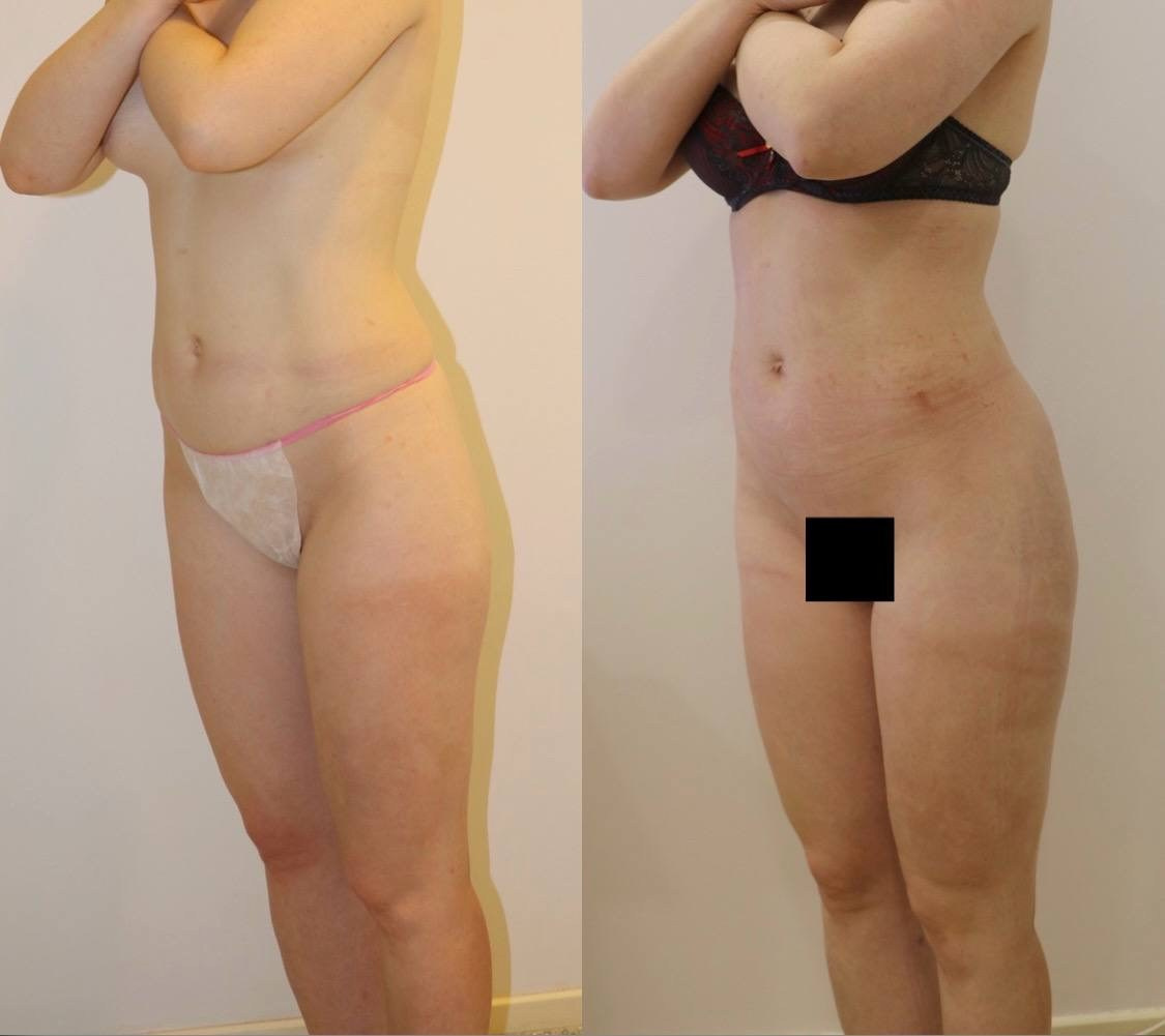 Результат липоскульптурирования и липомоделирования. Горбачевская Ксения Андреевна — пластический хирург