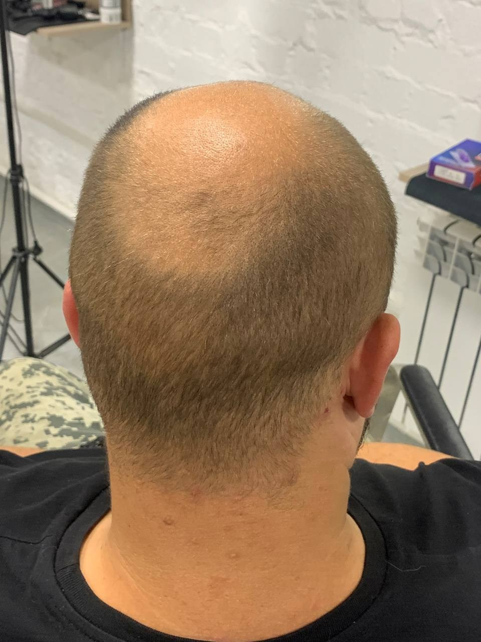 Нажмите на фото что бы открыть. SMP Трихопигментация Воронеж Волгоград Москва Казань Никита Нестеров