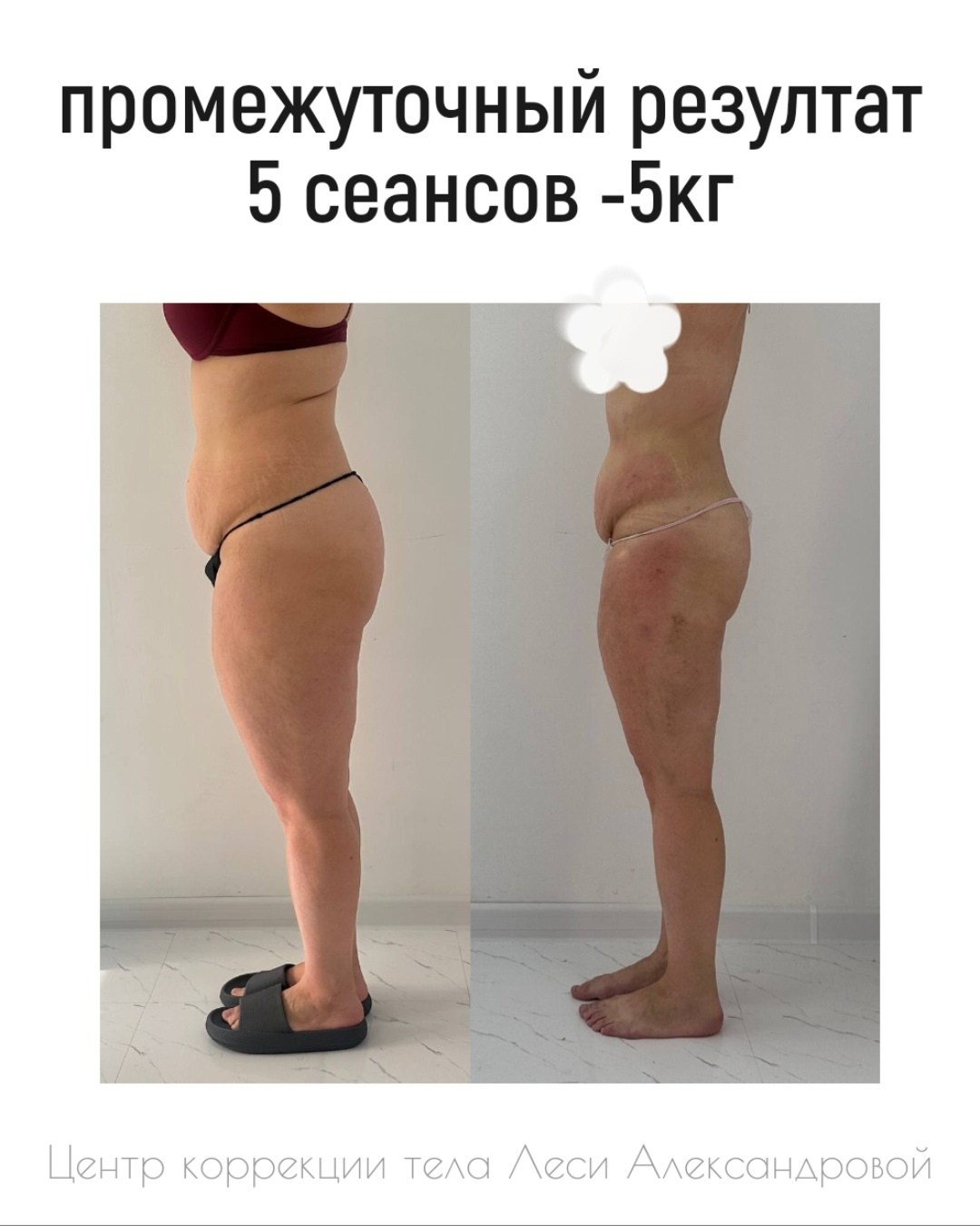 Результаты. Центр Коррекции Тела в городе Чехов