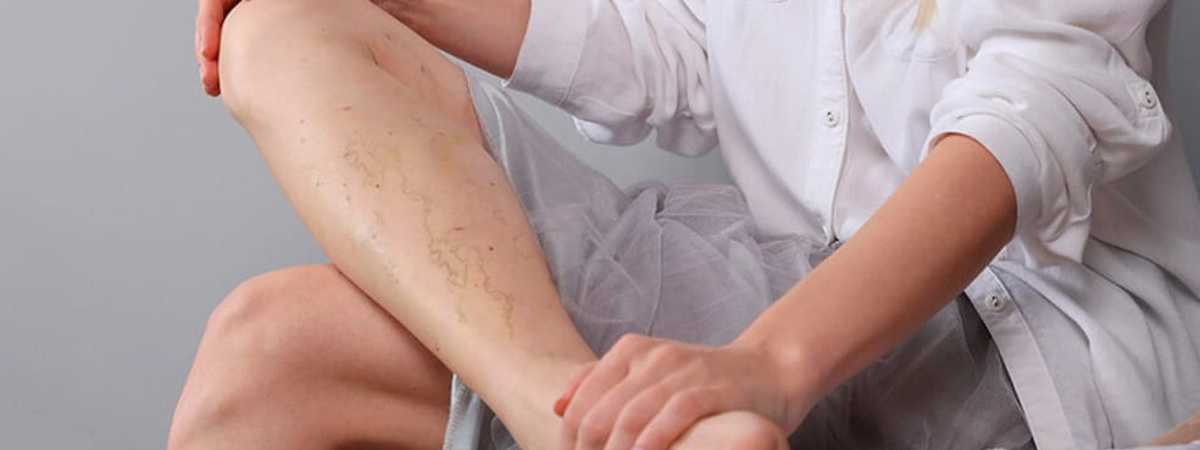 Варикозное расширение вен, геморрой. «Сово-Сова» продукция для омоложения, здоровья и долголетия