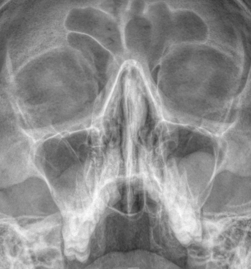 Разбираемся с пазухами на рентгене. Первые шаги. РЕНТГЕН КТ МРТ в Санкт-Петербурге Александра Лоншакова