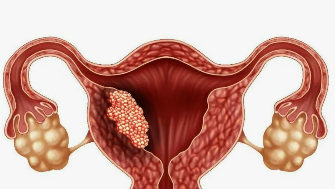 Полипы, кисты женских половых органов - какими препаратами компании Сово-Сова лечить