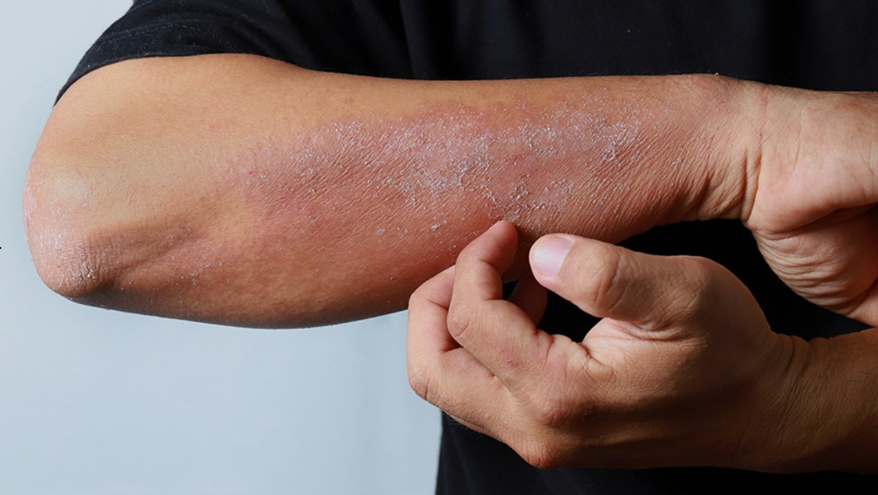 Кожные заболевания: акне, постакне, псориаз, нейродермит, экземы. атопический дерматит - какие препараты Сово-Сова помогут