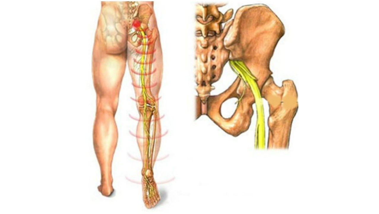 Неврастения, невралгия седалищного нерва - лечение препаратами компании Сово-Сова