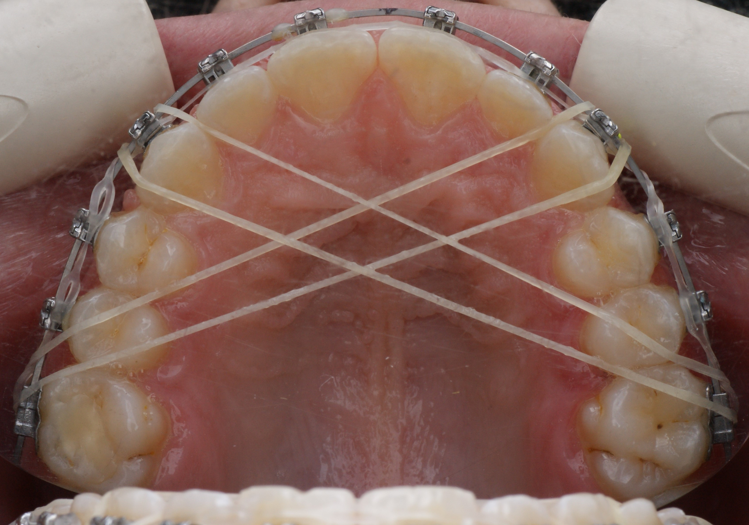 Блог врача. Стоматология «Ортодонт-Эстетик». Установка брекетов в Оренбурге, взрос