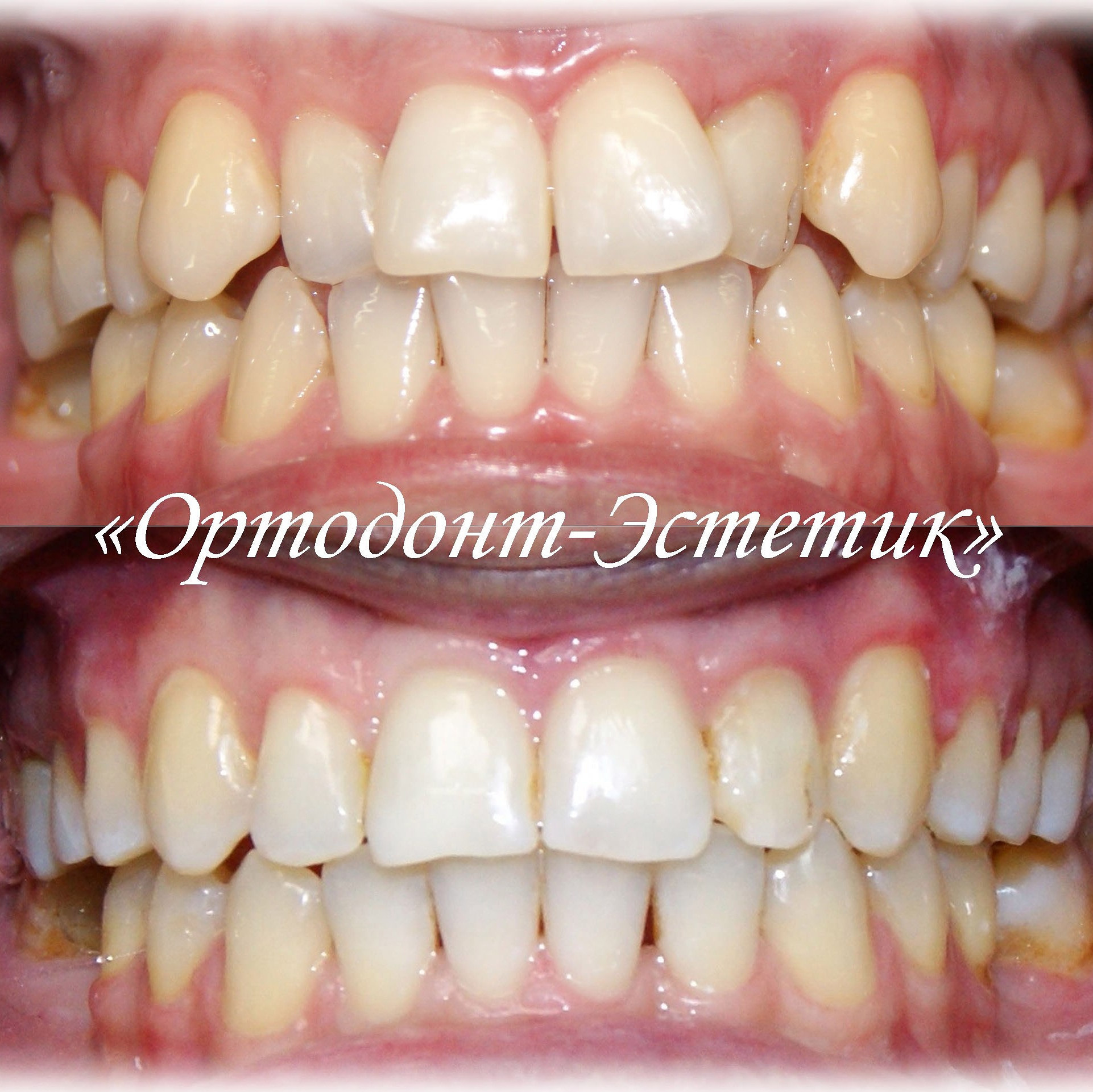 Блог врача. Стоматология «Ортодонт-Эстетик». Установка брекетов в Оренбурге, взрос