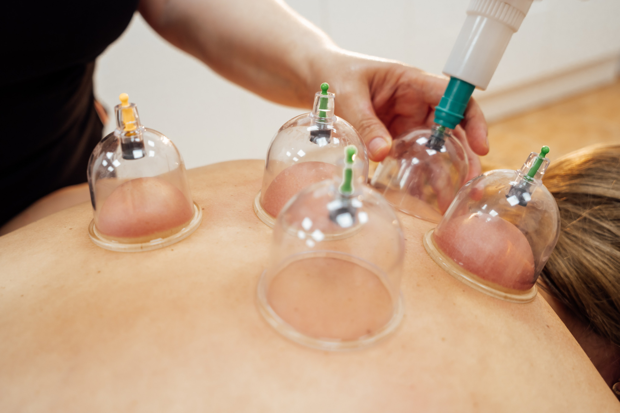 ВАККУМТЕРАПИЯ. Https://esmassage.ru