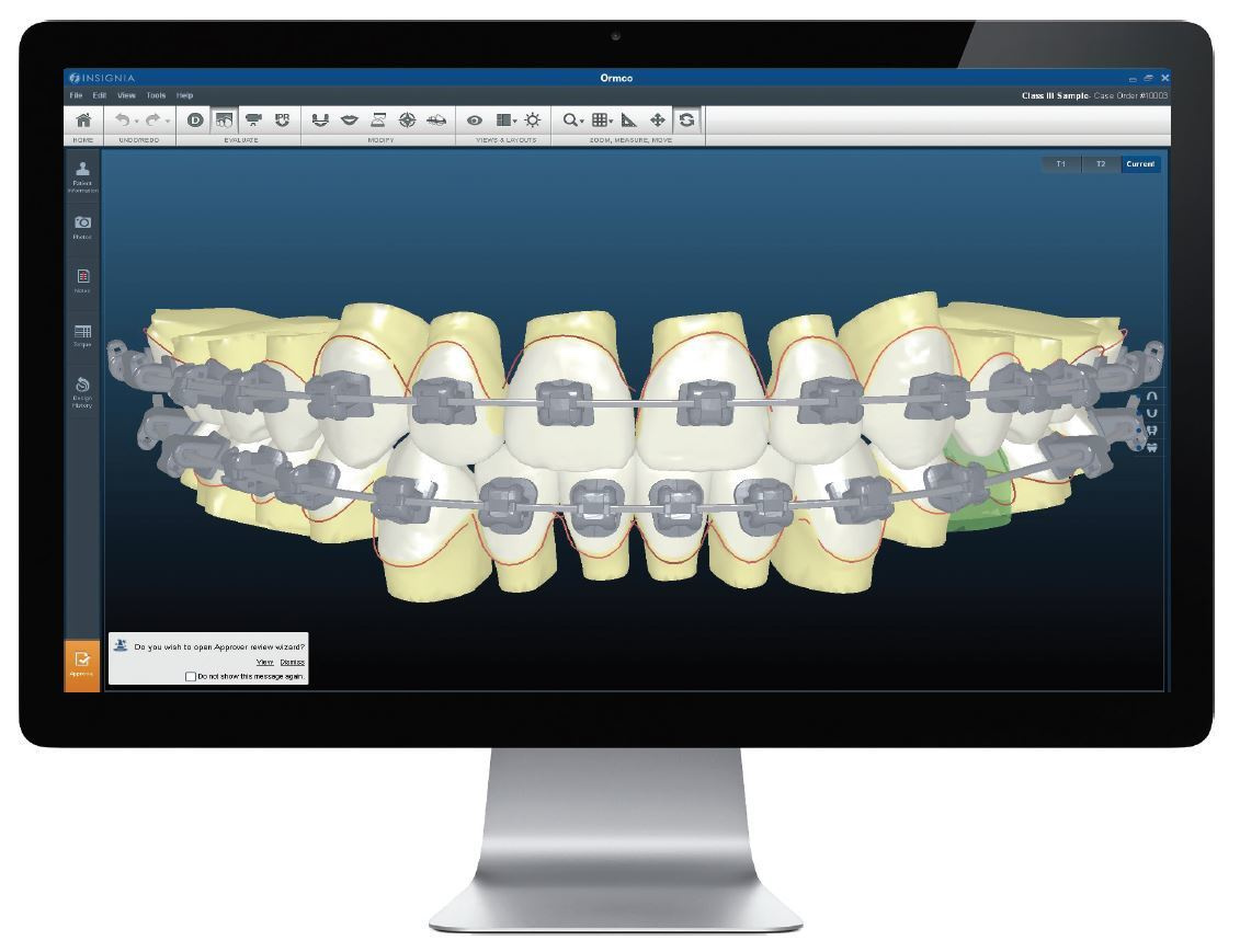 Индивидуальные брекеты, изготовленные по цифровым технологиям. Стоматология «Ортодонт-Эстетик». Установка брекетов в Оренбурге, взрос