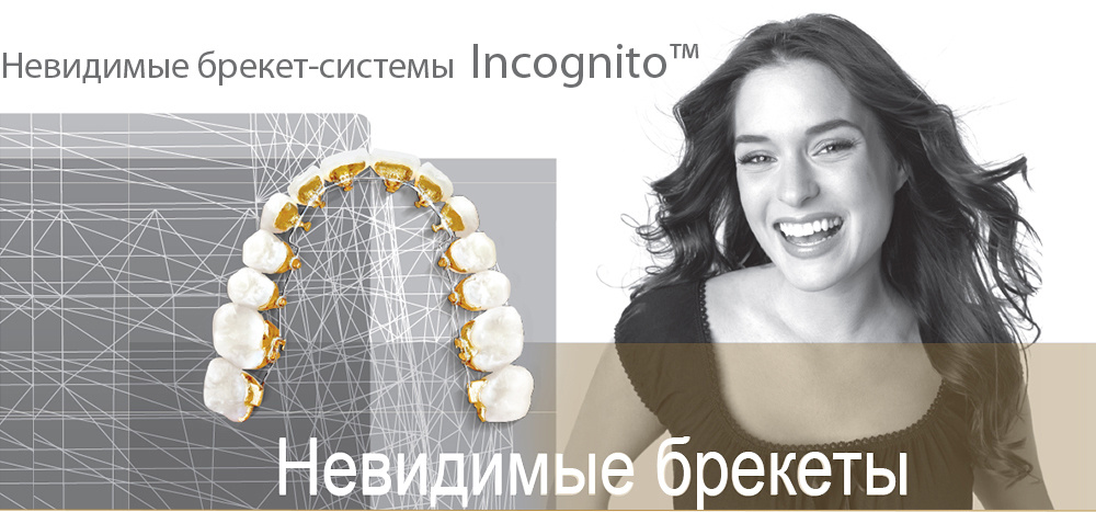 Лингвальные (внутренние) брекеты, которые не видны окружающим. Стоматология «Ортодонт-Эстетик». Установка брекетов в Оренбурге, взрос