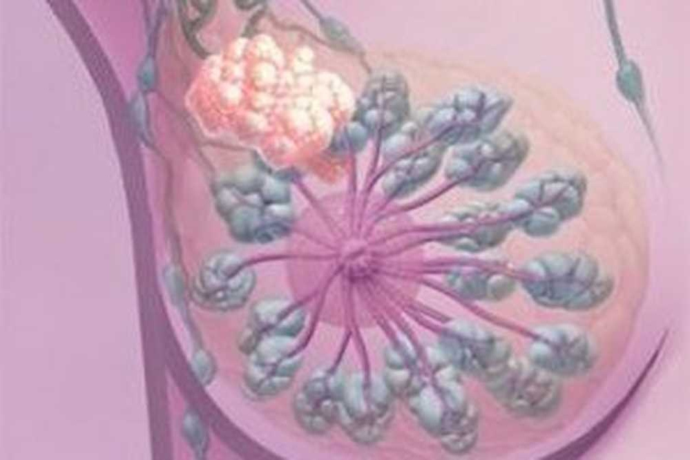 Узловая мастопатия - какие препараты компании Сово-Сова  принимать при узловой мастопатии