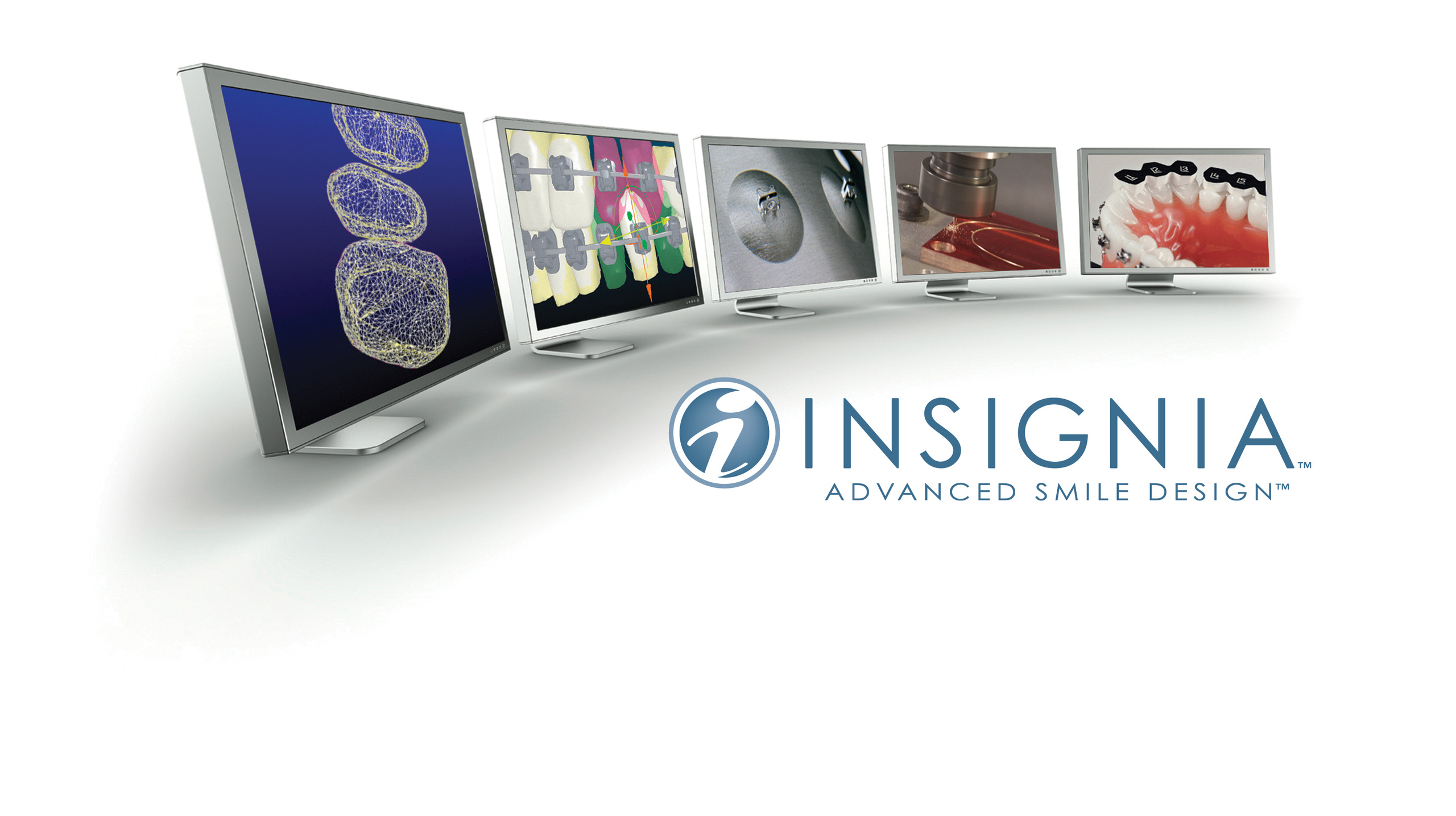 Индивидуальные брекеты, изготовленные по цифровым технологиям. Стоматология «Ортодонт-Эстетик». Установка брекетов в Оренбурге, взрос