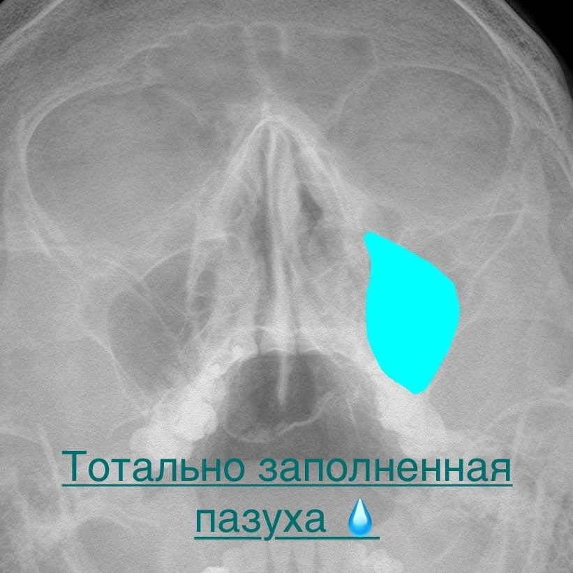 Разбираемся с пазухами на рентгене. Первые шаги. РЕНТГЕН КТ МРТ в Санкт-Петербурге Александра Лоншакова