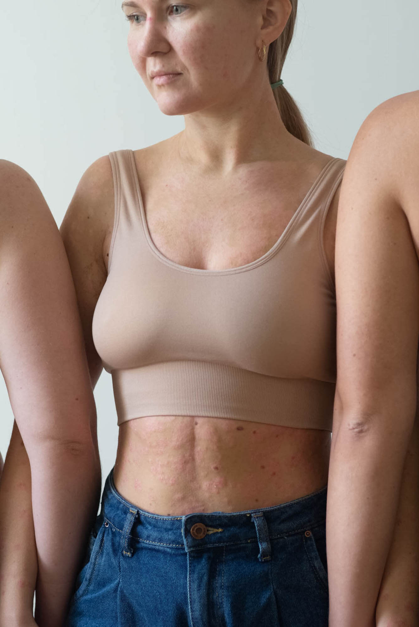 документальная фотография в псориаз