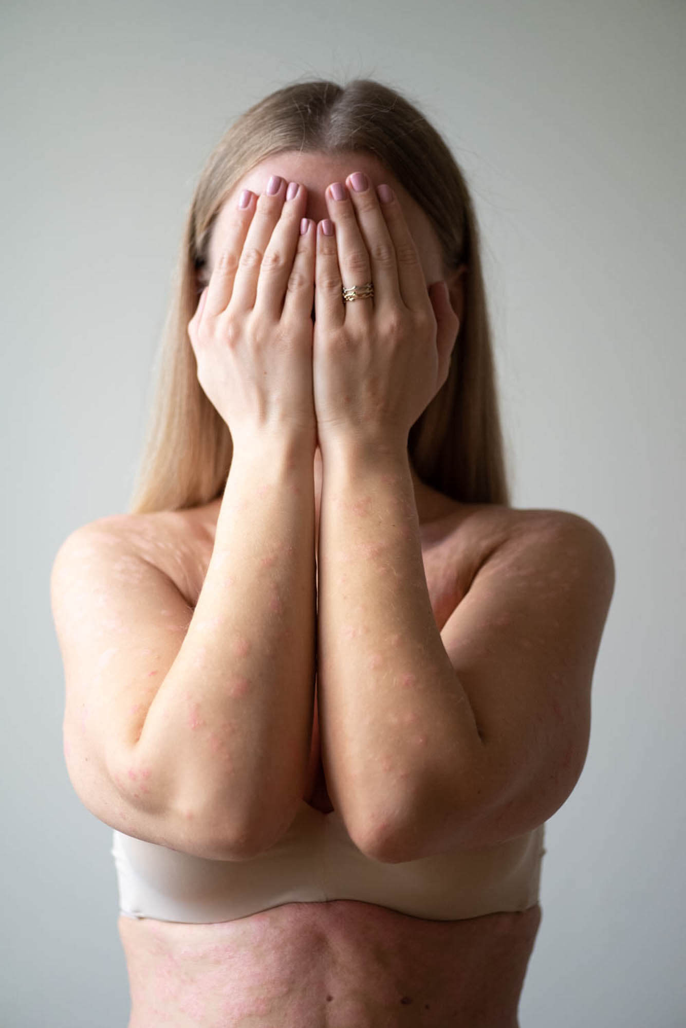 портрет девушки в псориаз