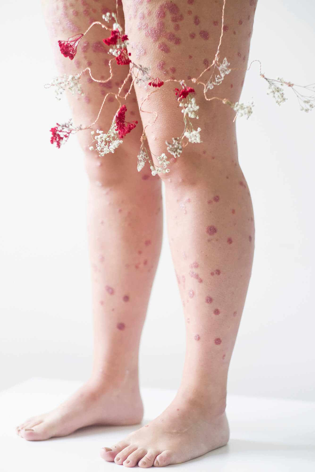 портрет тела в псориаз