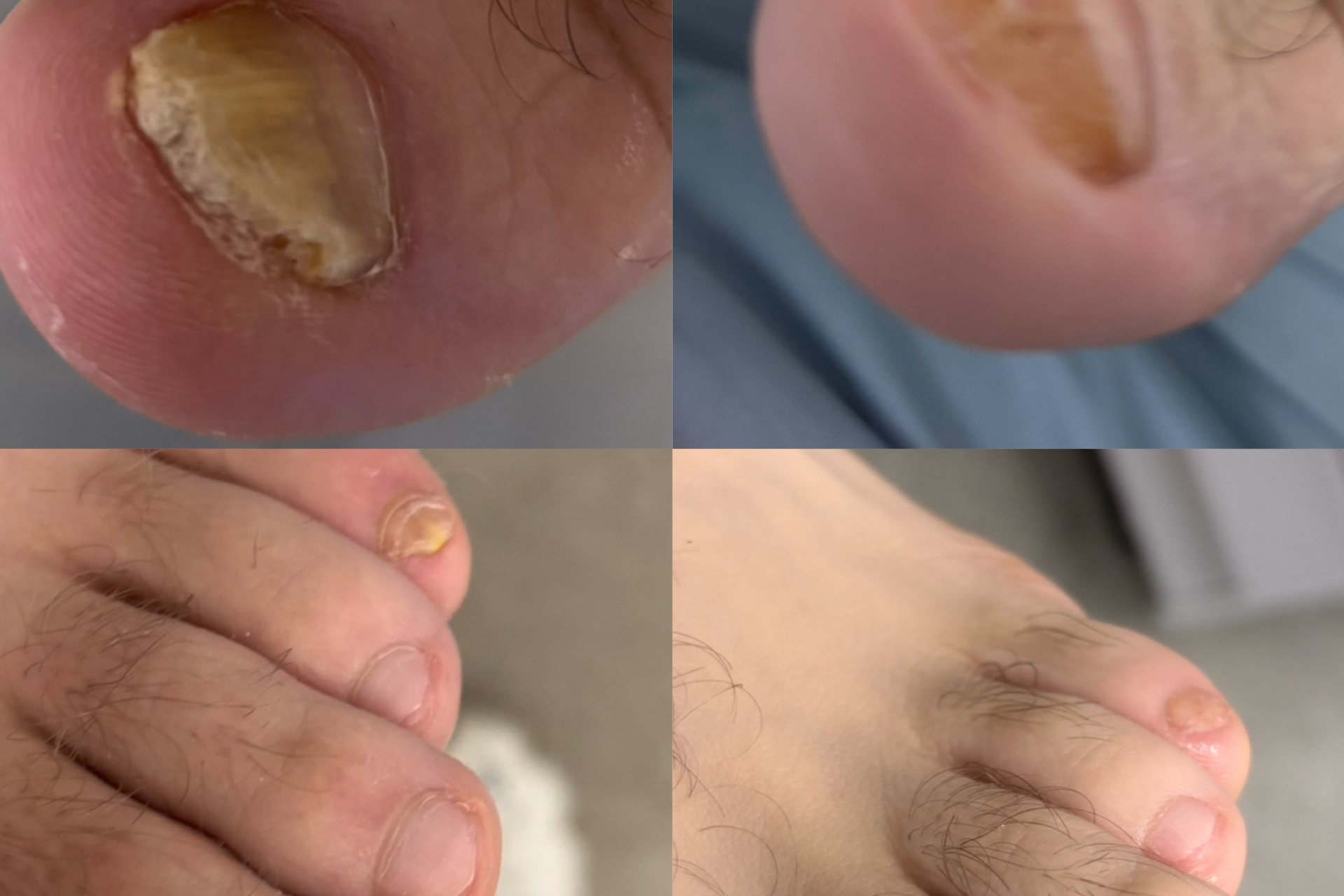 Экзостоз у девочки 13 лет. Подолог г. Хабаровск — центр здоровой стопы «FOOTTIME»