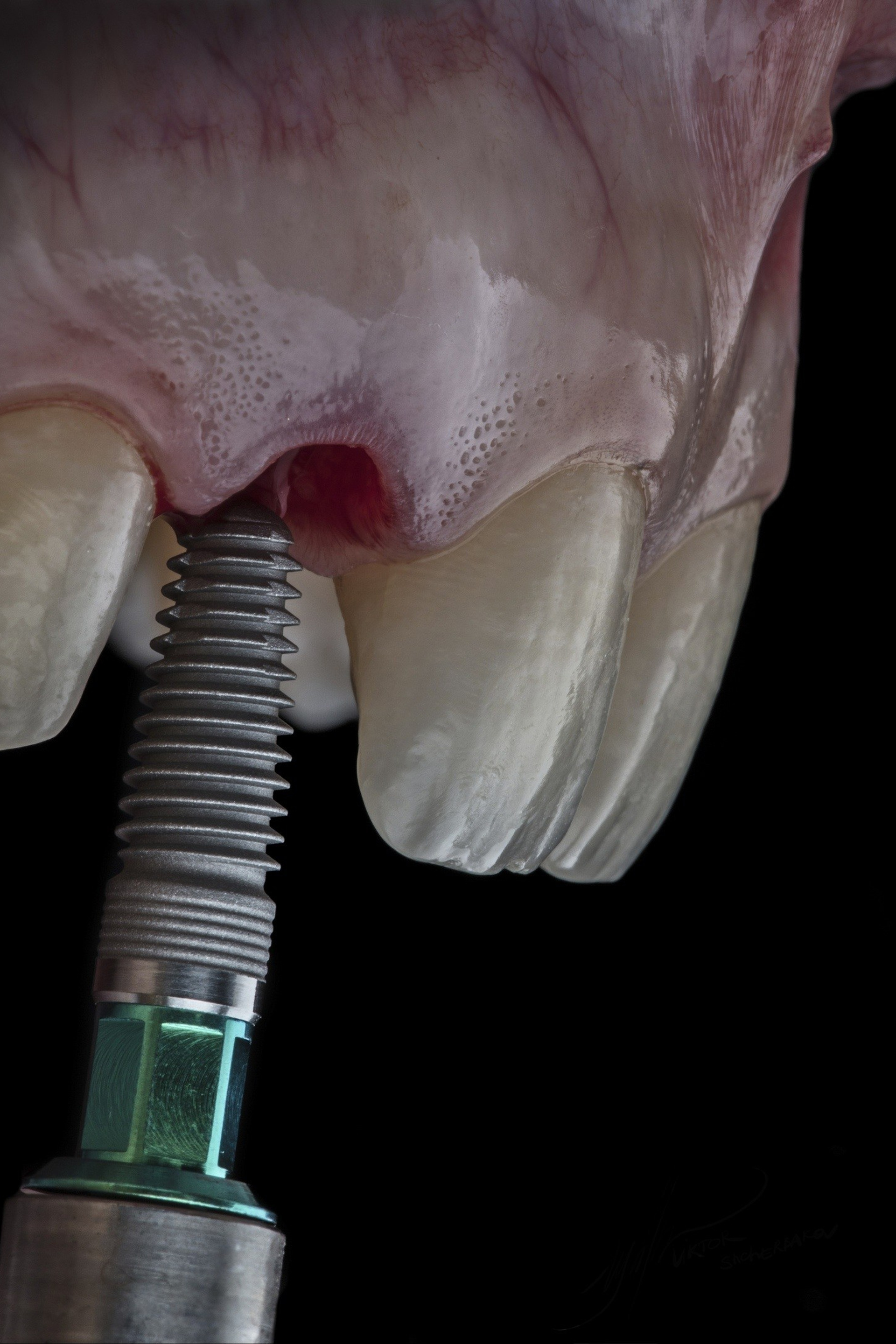 Имплантация (All on 4/ All on 6/ одиночный имплантат)