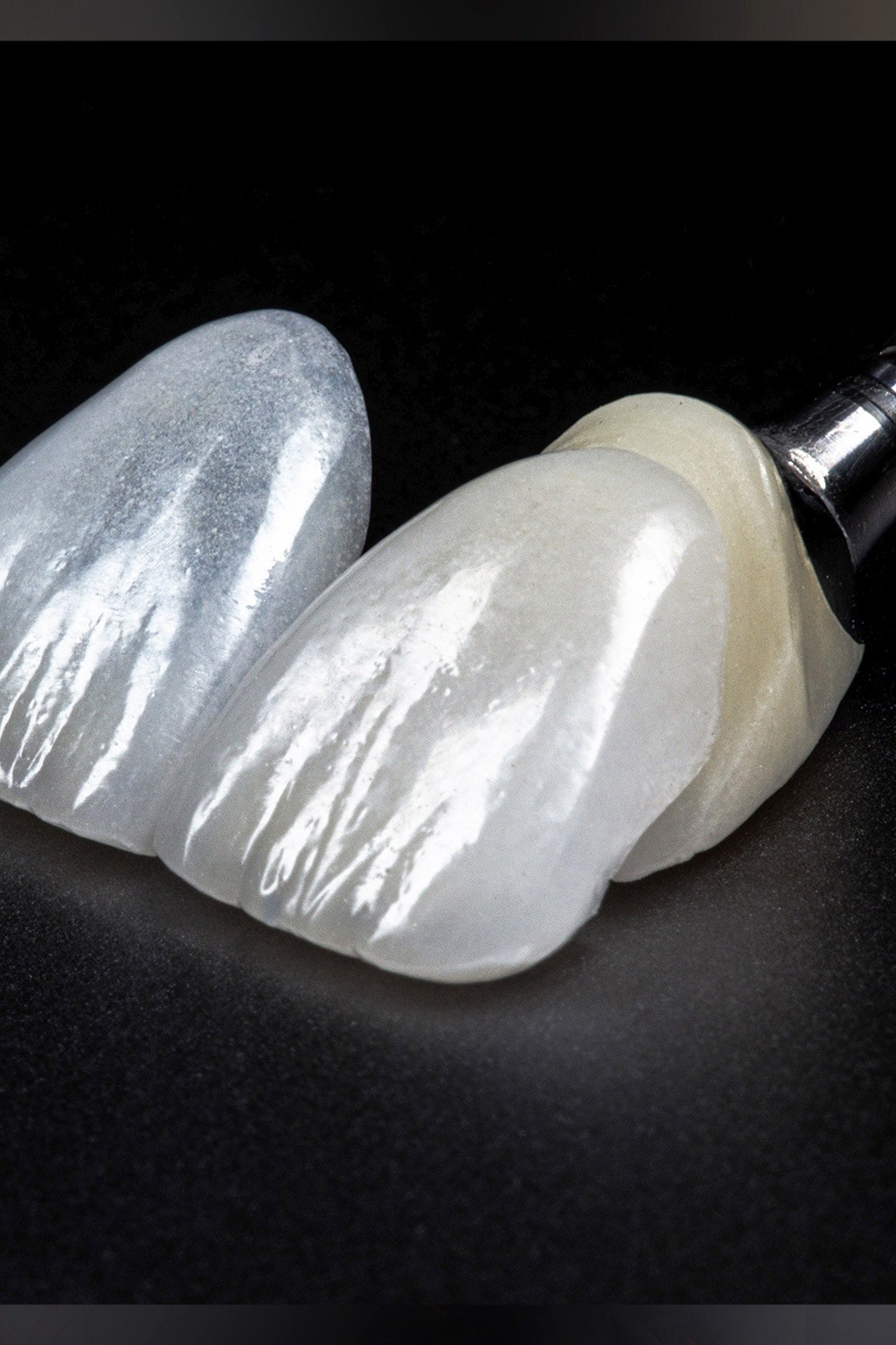 Керамические реставрации (виниры, коронки, вкладки)