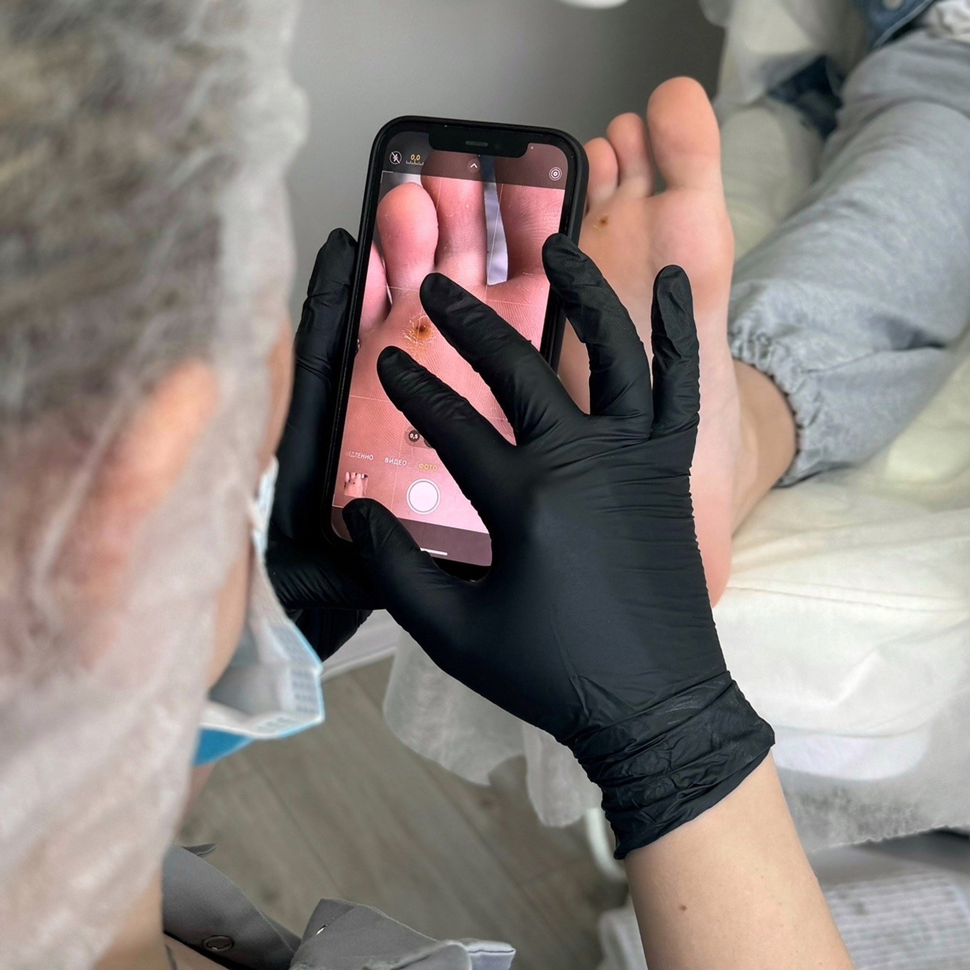 Комплексная подологическая обработка ногтей и стопы 2 степень (сухость, шелушение кожи, избыточное ороговение, трещины, незначительно деформирована ногтевая пластина) - 4 000 ₽