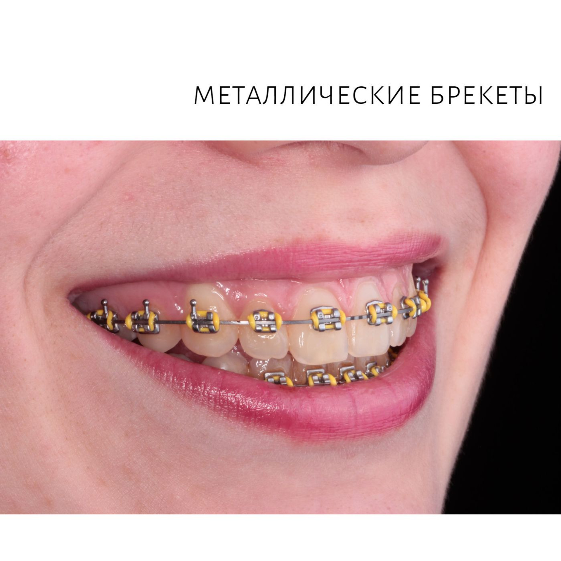 Ортодонтия. Стоматология в Твери - Линия Улыбки