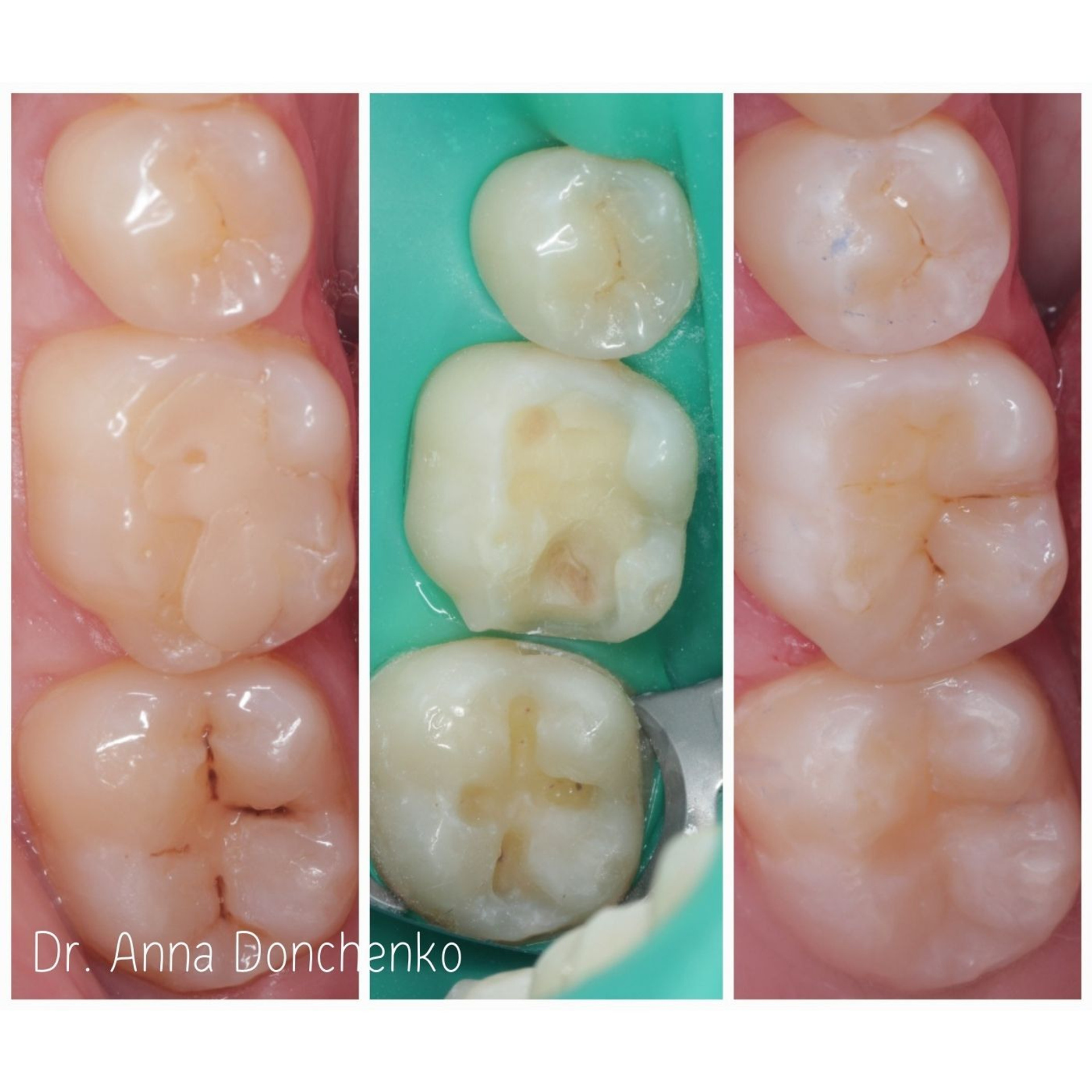 Стоматология в Твери - Линия Улыбки Лечение кариеса. Стоматология в Твери - Линия Улыбки