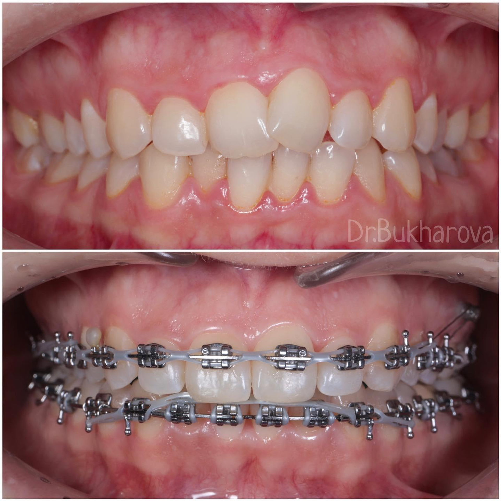 Ортодонтия. Стоматология в Твери - Линия Улыбки