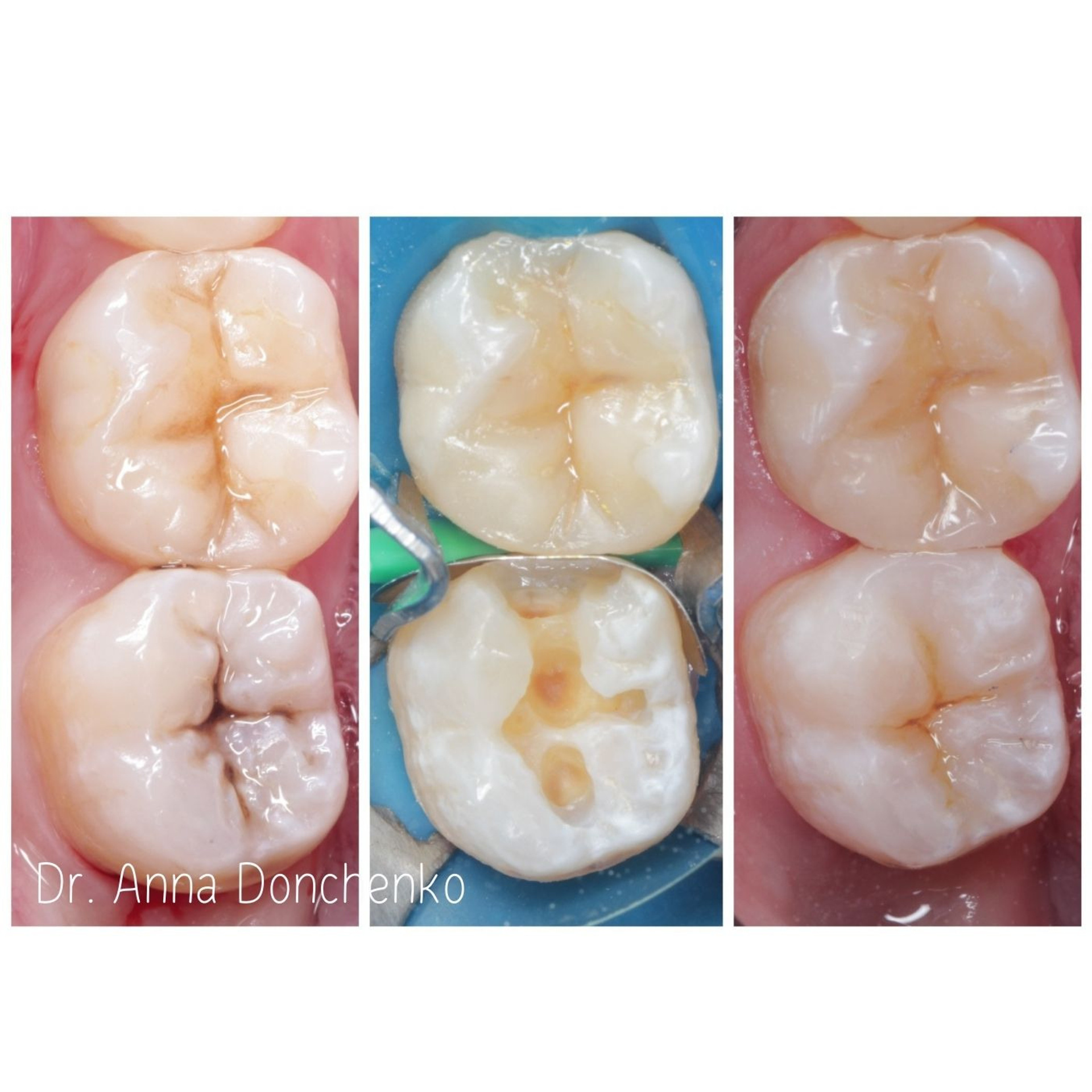 Стоматология в Твери - Линия Улыбки Лечение кариеса. Стоматология в Твери - Линия Улыбки