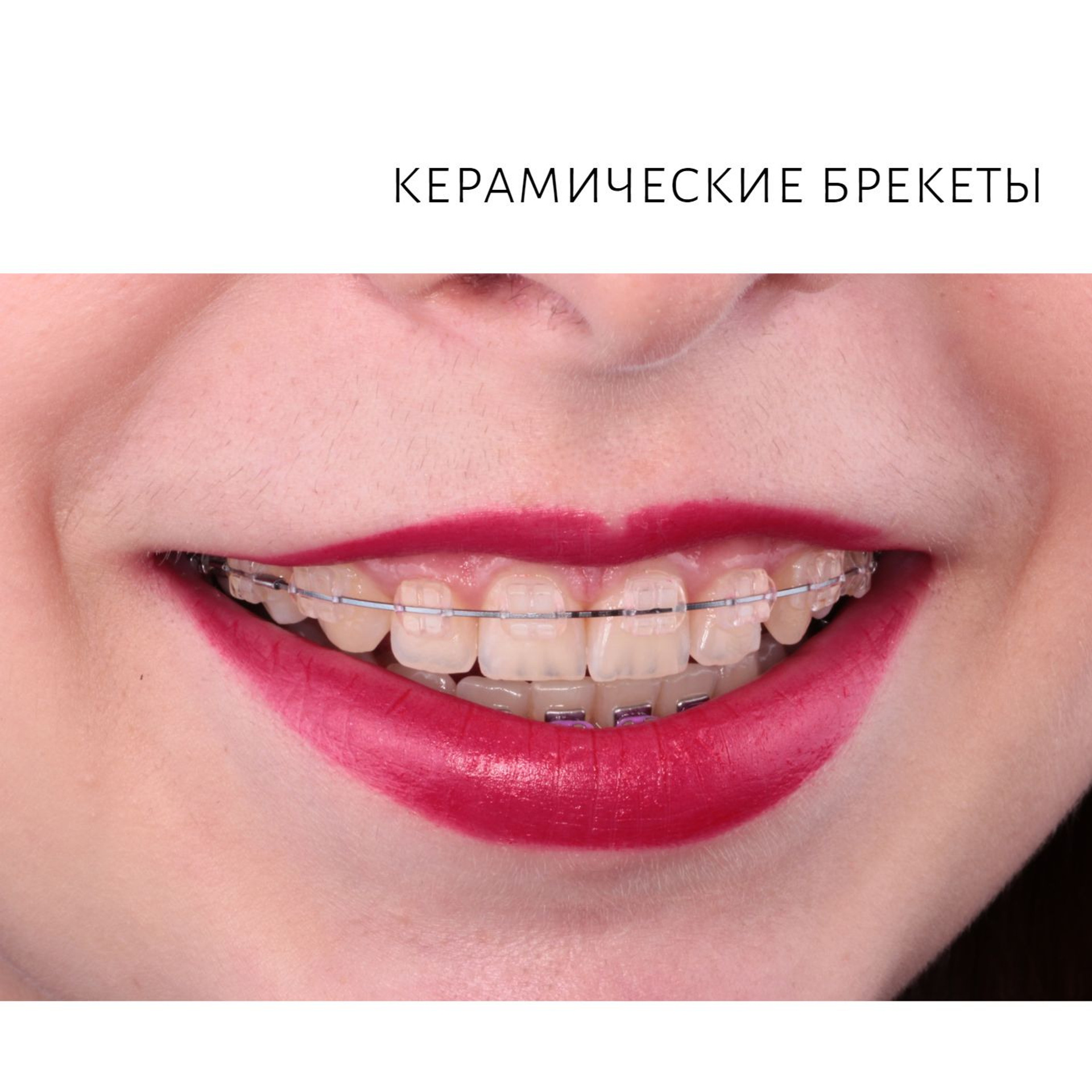 Ортодонтия. Стоматология в Твери - Линия Улыбки