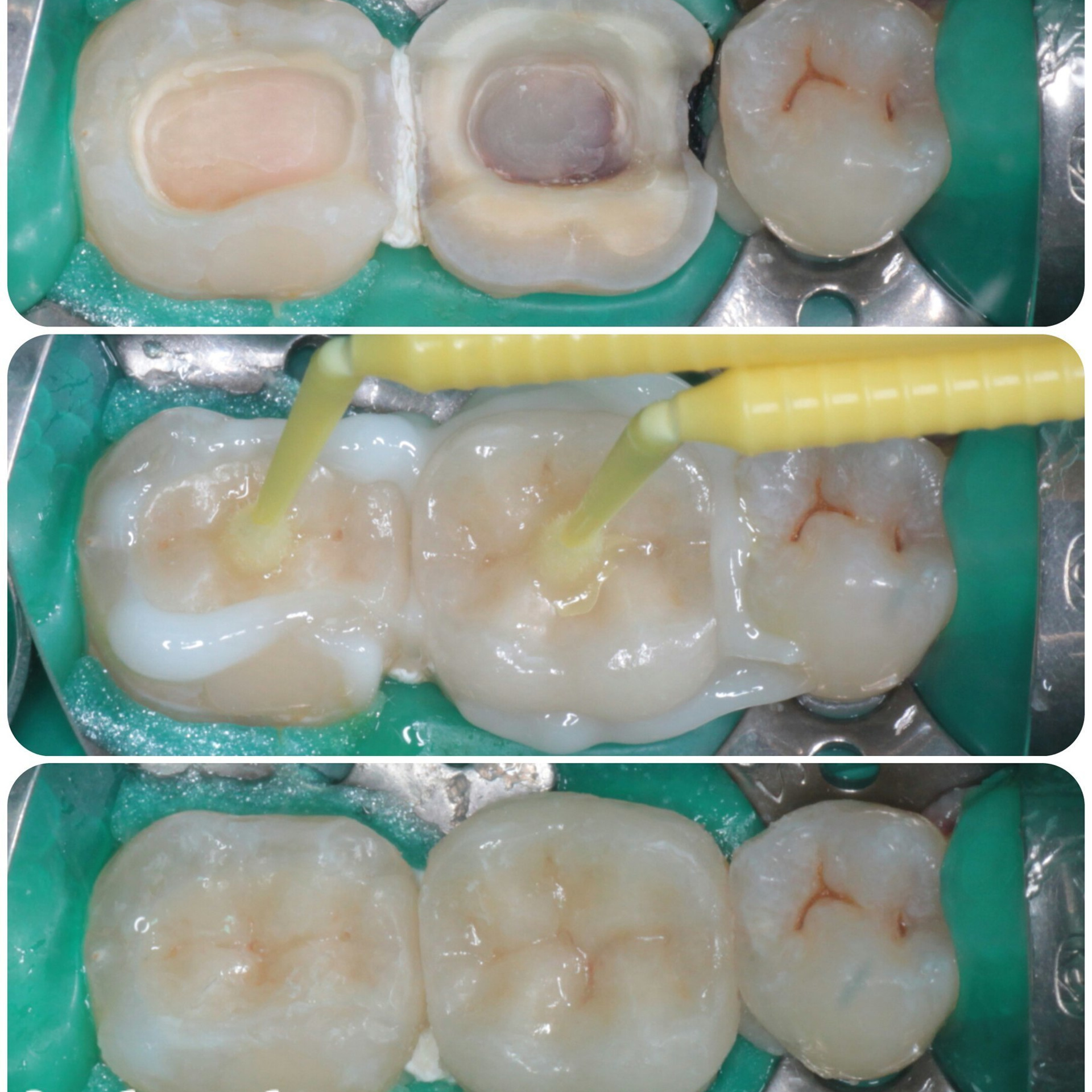 цельнокерамическая вкладка,керамическая вкладка,протезирование зубов,тверь,линия улыбки тверь,стоматология,филиппов илья юрьевич,стоматолог