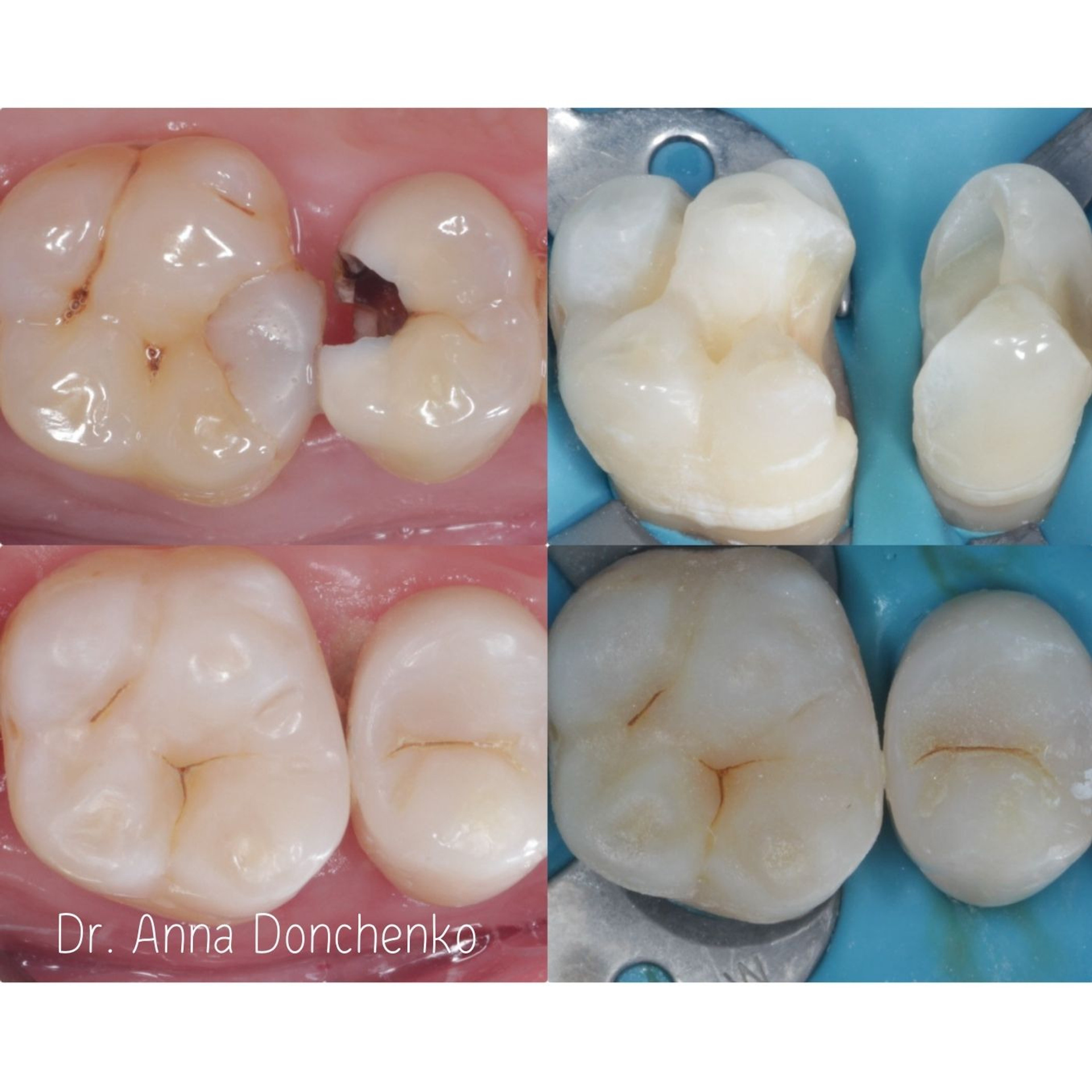 Стоматология в Твери - Линия Улыбки Лечение кариеса. Стоматология в Твери - Линия Улыбки