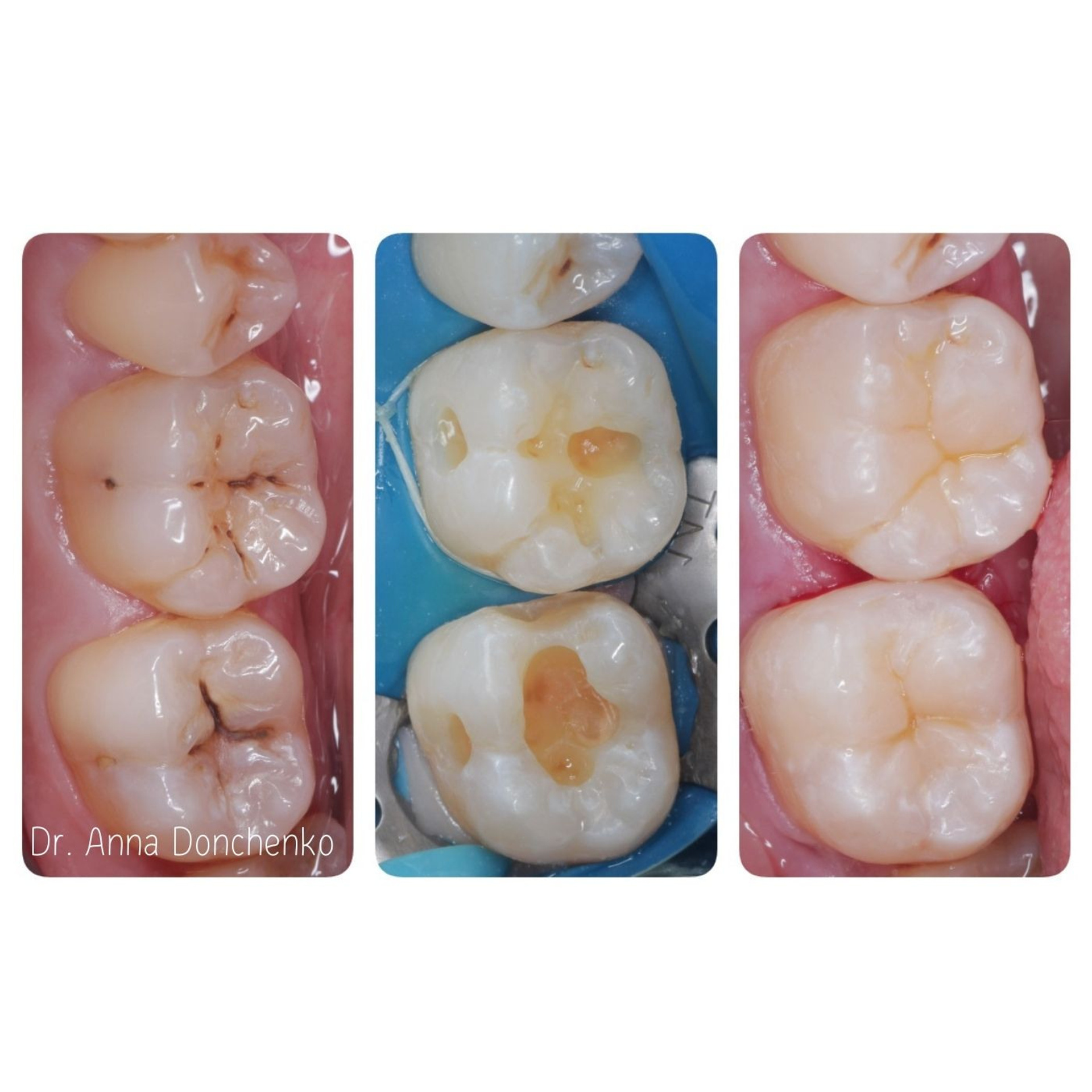 Стоматология в Твери - Линия Улыбки Лечение кариеса. Стоматология в Твери - Линия Улыбки