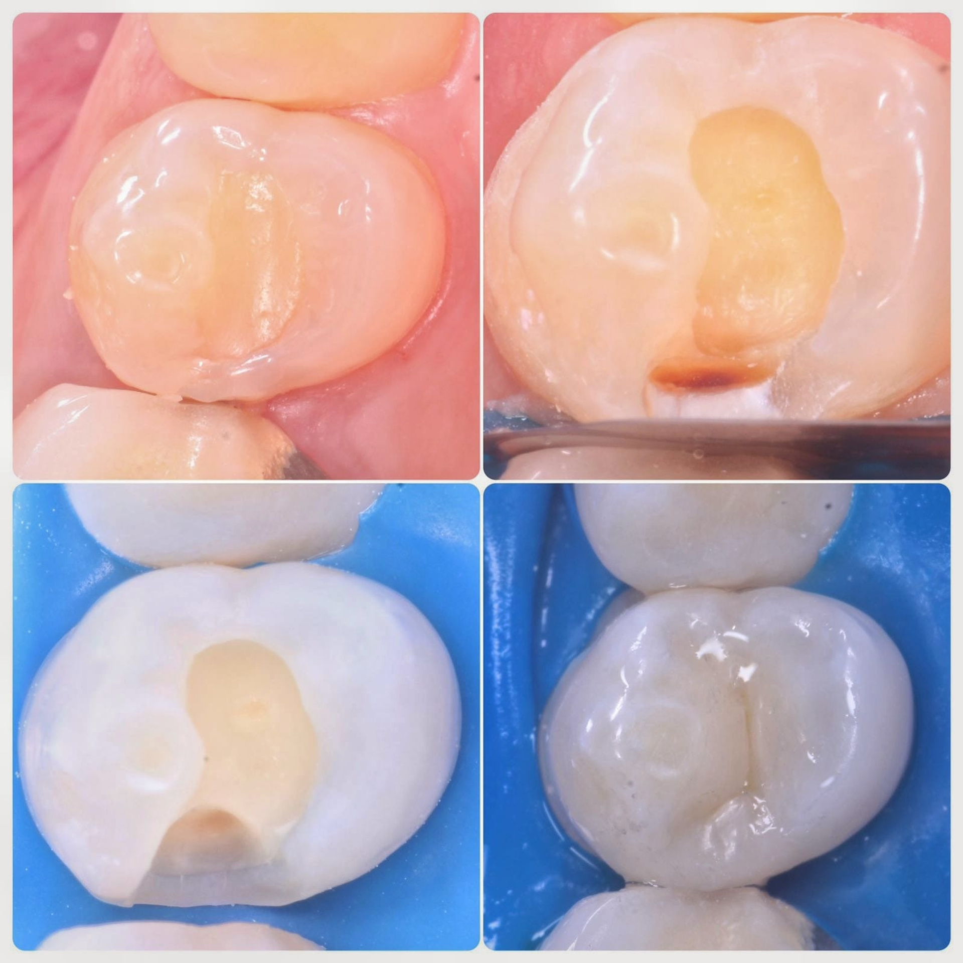 Стоматология в Твери - Линия Улыбки Лечение кариеса. Стоматология в Твери - Линия Улыбки