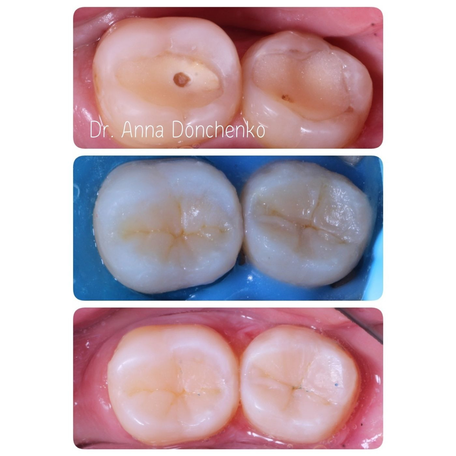 Стоматология в Твери - Линия Улыбки Лечение кариеса. Стоматология в Твери - Линия Улыбки