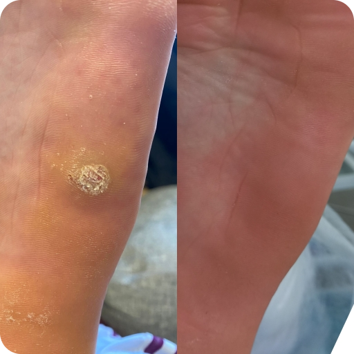 Бородавка. Подолог г. Хабаровск — центр здоровой стопы «FOOTTIME»