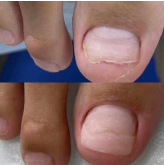 Протезирование ногтя. Подолог г. Хабаровск — центр здоровой стопы «FOOTTIME»